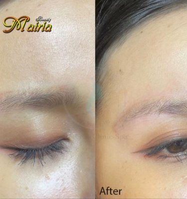 Xoá sửa mày trổ xanh trổ đỏ 