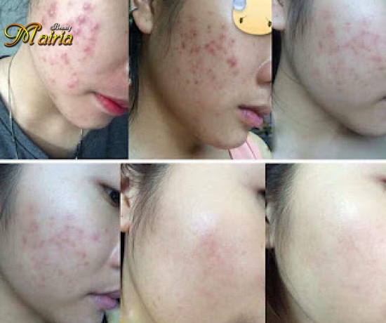 Trị mụn hoa anh đào