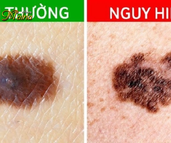 Xoá sửa mày trổ xanh trổ đỏ 