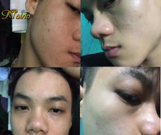 Trị mụn hoa anh đào