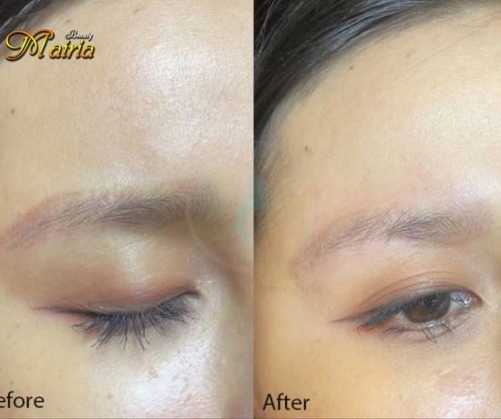 Xoá sửa mày trổ xanh trổ đỏ 