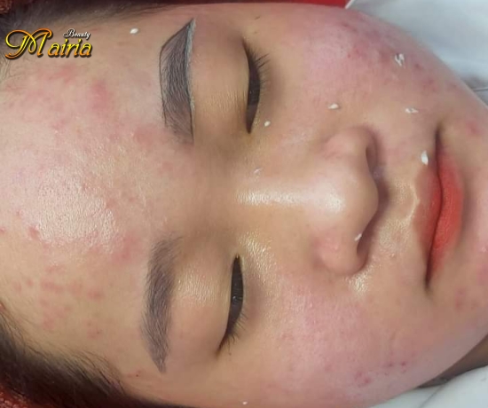 Phun môi collagen - phun mày điêu khắc sợi mày nam nữ 