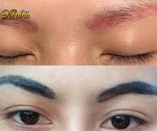 Xoá sửa mày trổ xanh trổ đỏ 