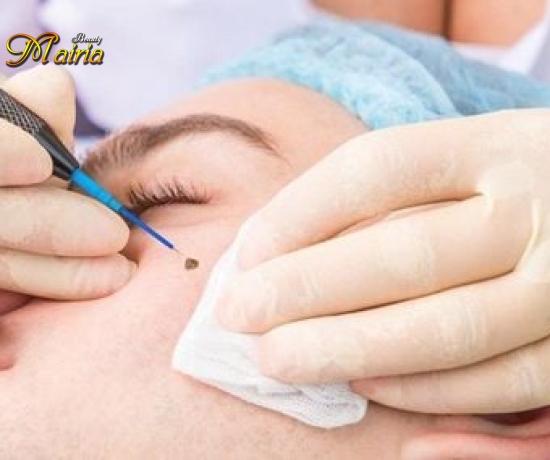 Xoá sửa mày trổ xanh trổ đỏ 