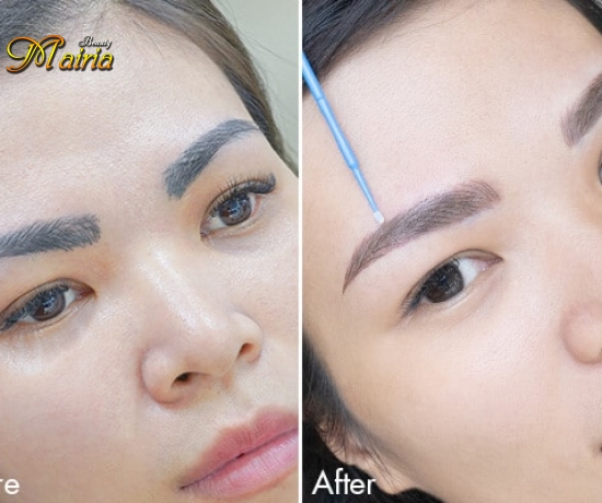 Quy trình thực hiện xoá sửa mày trổ xanh trổ đỏ 